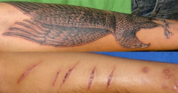 τατουάζ για να καλύψει ουλή αυτοτραυματισμού