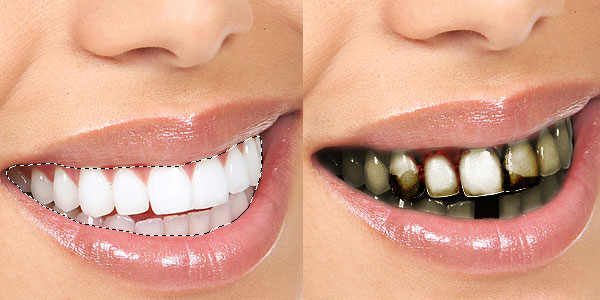 Παραποίηση οδοντιατρικής διαφήμισης: Από πανέμορφη σε ακαθάριστη - Αντίστροφη καλλυντική οδοντιατρική